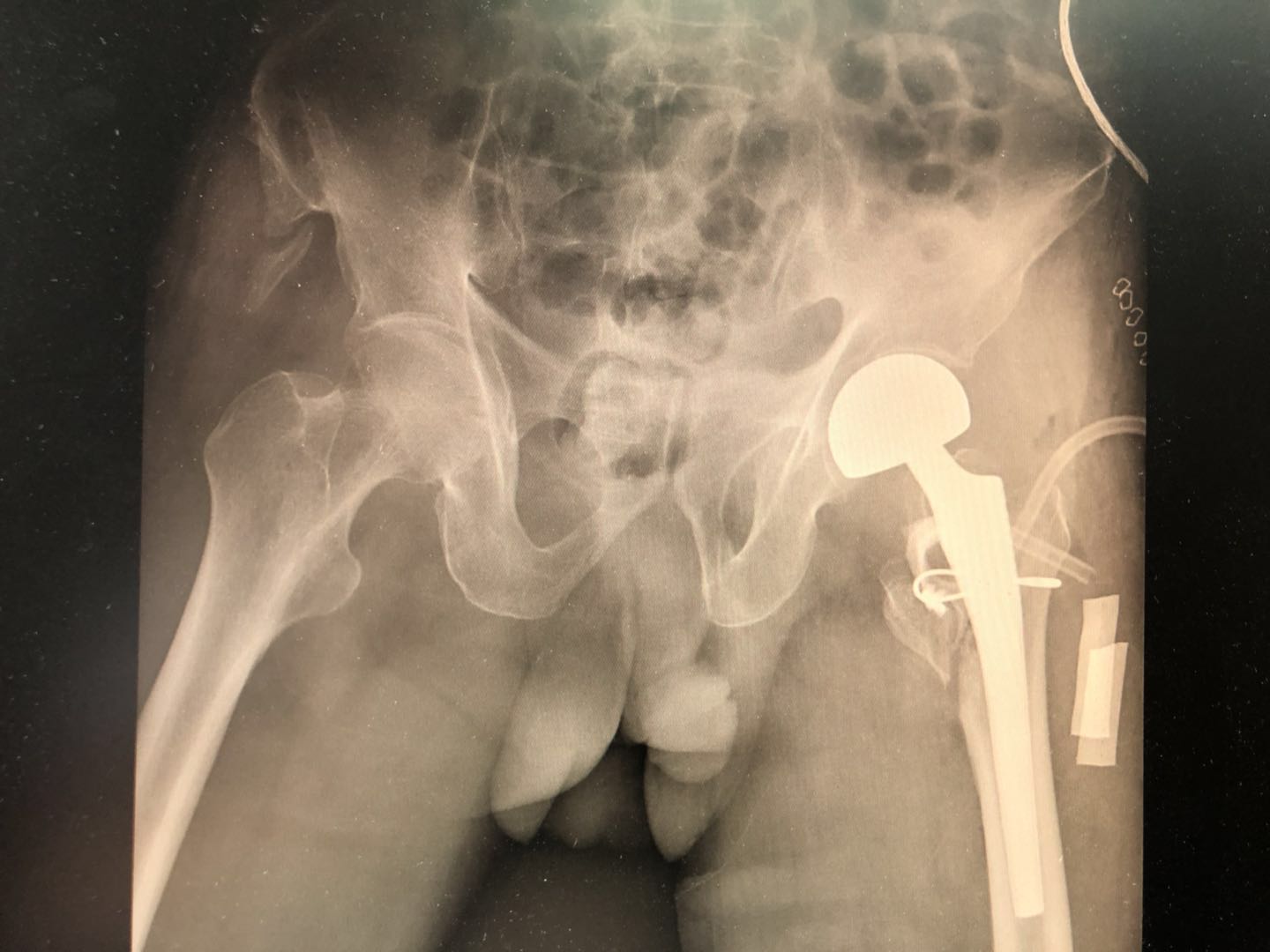 老年人骨折了需要手术吗,老年人胸椎骨折手术治疗风险