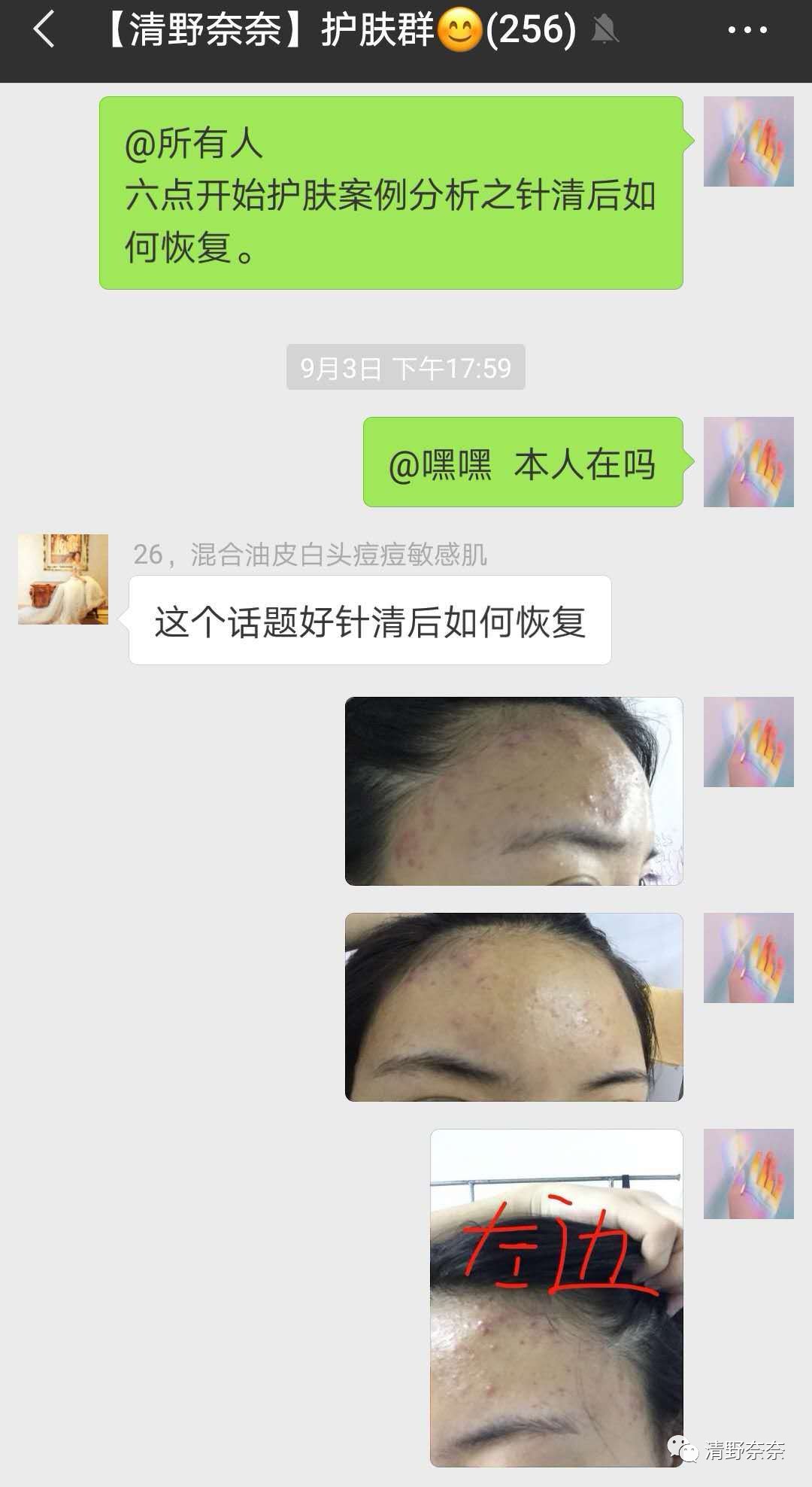 海绵微针后怎么护理,海绵微针第二天怎么护理