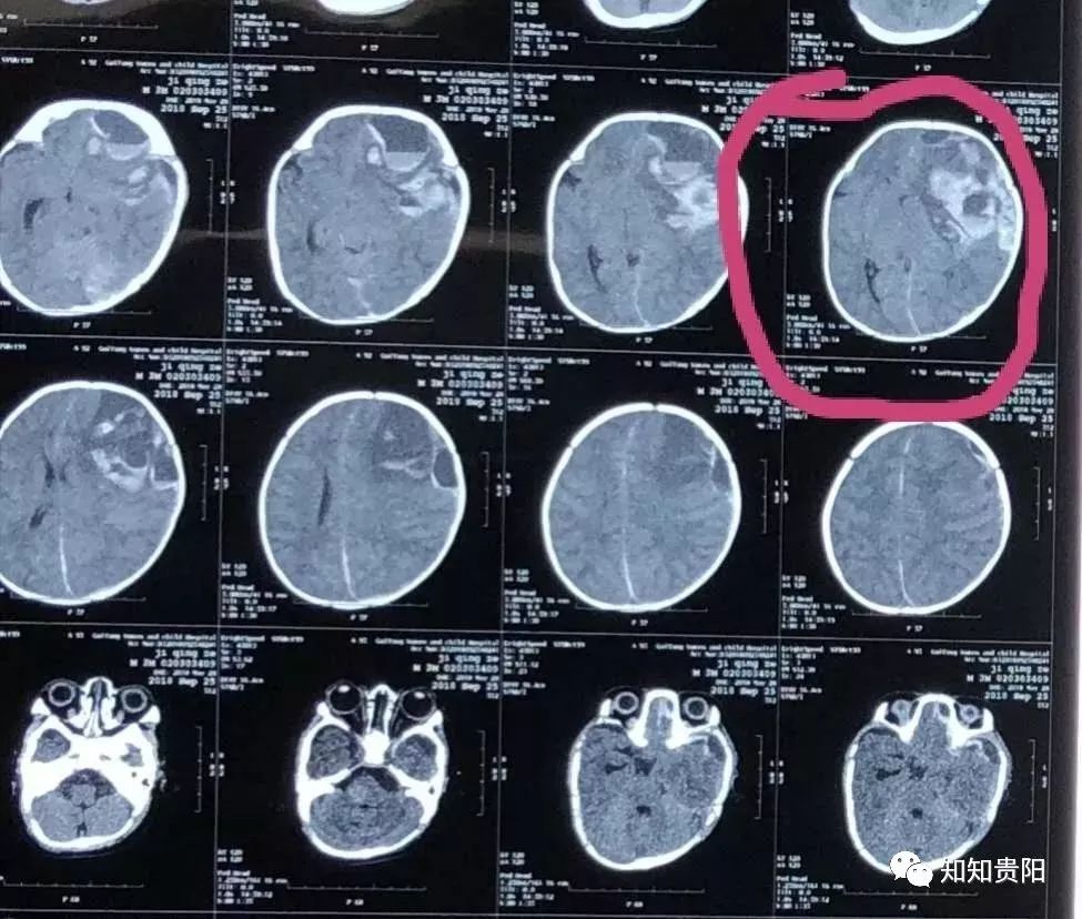 一岁宝宝脑出血手术成功率大吗,婴儿脑血管畸形脑出血后手术