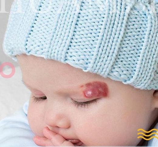 血管瘤的症状是什么怎么治疗,血管瘤的症状与治疗方法