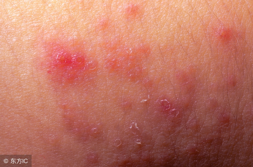 幼儿尖锐湿疣的症状有哪些呢