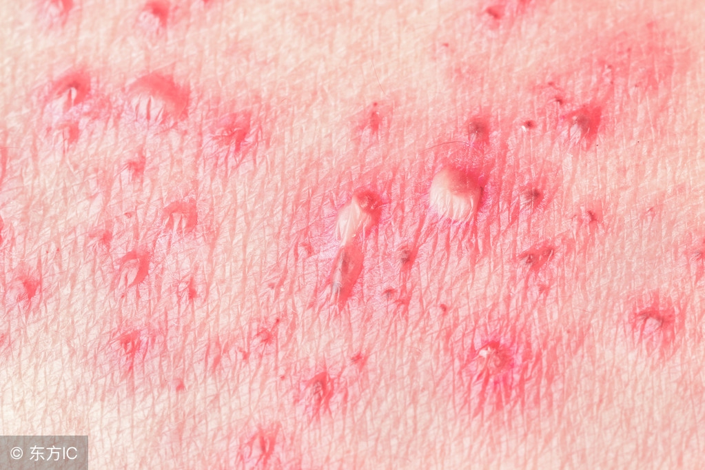 带状疱疹治疗方法和注意事项,带状疱疹治疗方法与注意事项