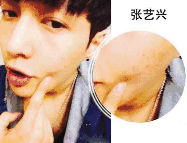 祛痘的神器,祛痘神器推荐额头起了很多痘