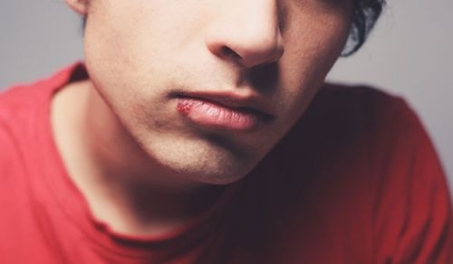 莫匹罗星软膏可以治疗嘴角起泡吗,孩子经常嘴角烂嘴角起泡怎么办