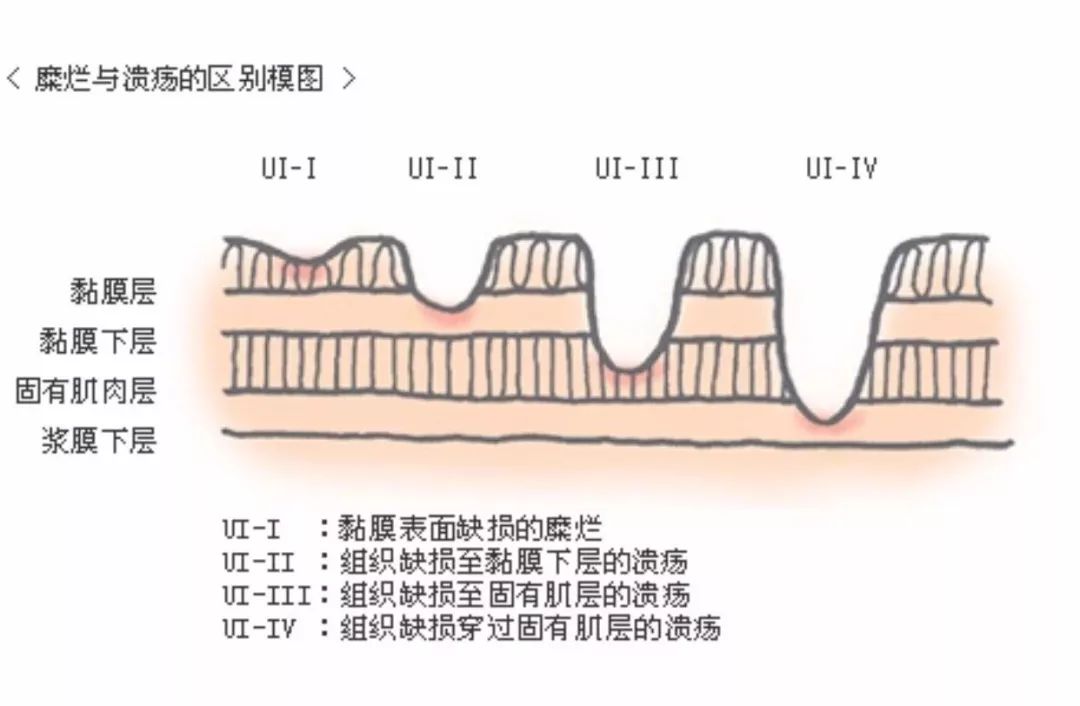 胃溃疡和胃糜烂区别哪个更严重,胃糜烂与胃溃疡哪个更严重