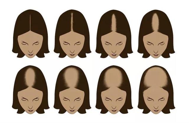 一个方法判断你是否有脱发,造成脱发的原因无非就这5个