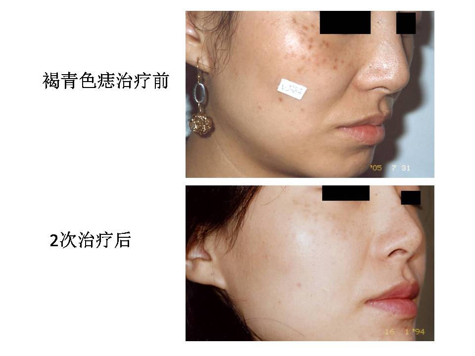 什么斑去除就不再复发了,各种斑淡化最有效的方法