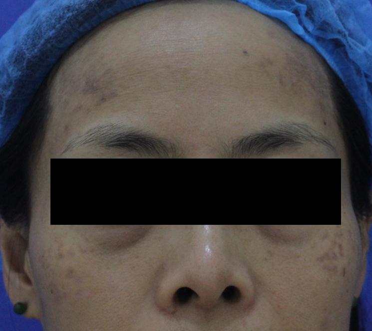 什么斑去除就不再复发了,各种斑淡化最有效的方法