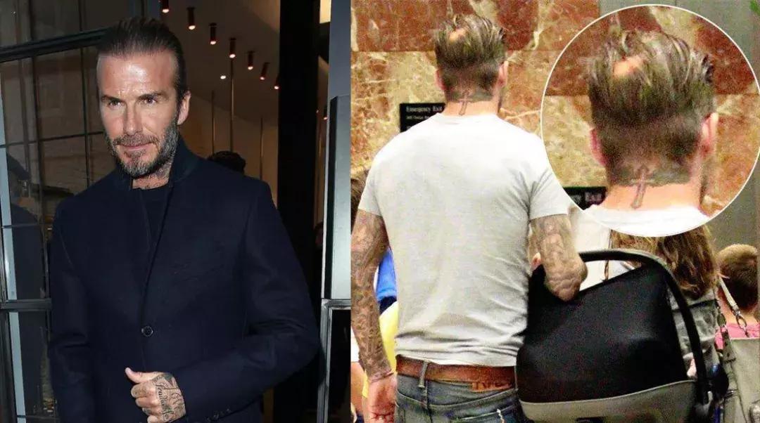 有许多明星脱发是怎样补救的,明星脱发都用什么方法