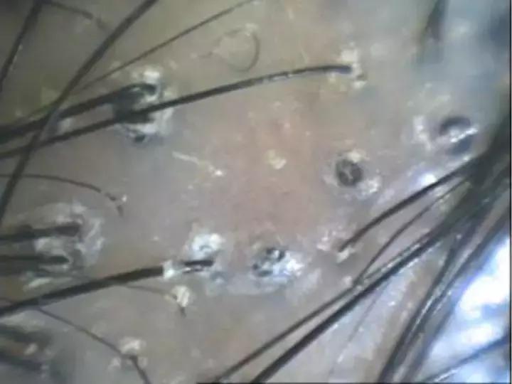 12岁女孩头皮屑咋治,十四岁青少年女孩头皮屑怎么解决