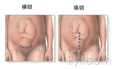 剖腹产的麻醉针,剖腹产最多可以剖几次