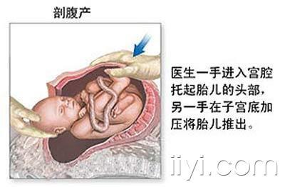 剖腹产的麻醉针,剖腹产最多可以剖几次