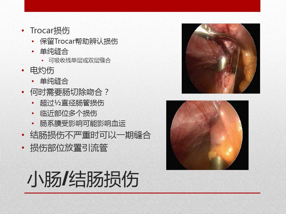泌尿外科腹腔镜手术适应症,泌尿外科腹腔镜并发症