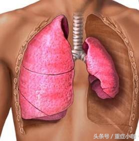 胸腔穿刺术常见并发症及处理方案,胸腔穿刺的主要并发症及处理要点