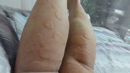 *麻疹荨**有哪些危害？该如何治疗和护理？一文让你读懂，这里都说了