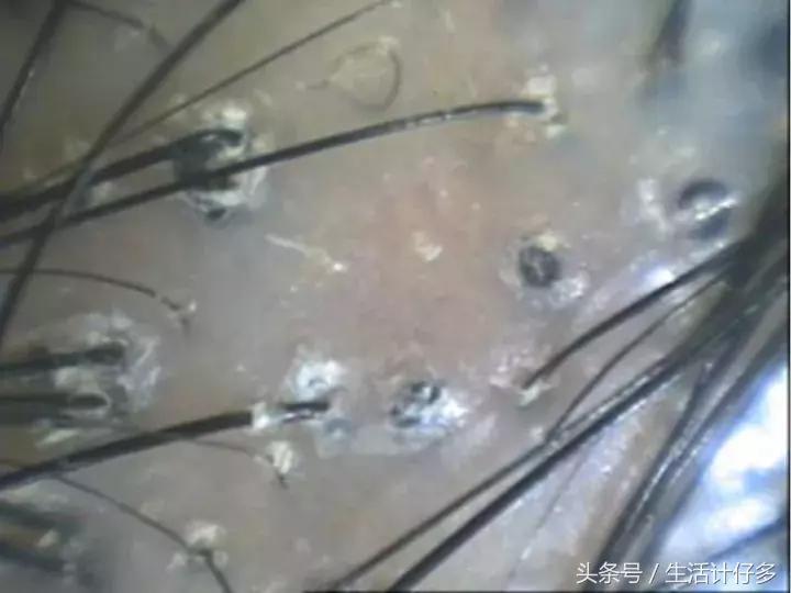 为什么全家人都有头皮屑,18岁女孩头皮屑多为什么