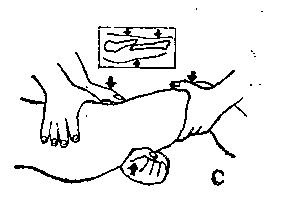 中医骨折治疗原则,中医骨伤整复术
