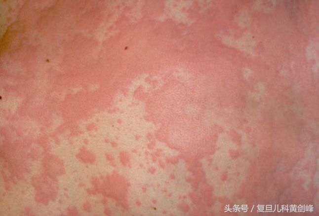 宝宝风疹块怎么引起的,宝宝身上起风疹块原因