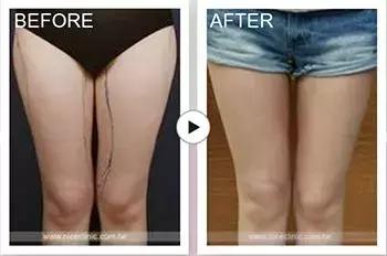 女人双腿空隙大是什么原因,女性双腿有缝隙是什么原因