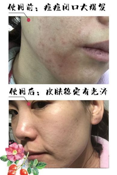 有了这瓶“液体黄金“,今年秋冬注定与干燥、长痘无缘了!