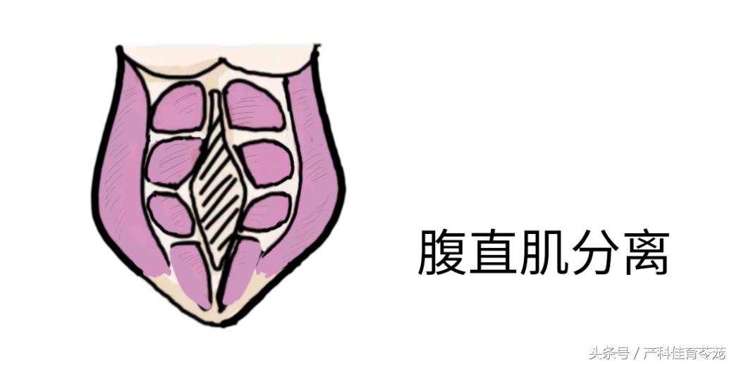 剖宫产辟谣,腹膜外剖宫产辟谣