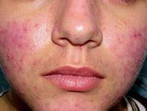 口鼻生疮的用药,内阴疮的中医辨证论治