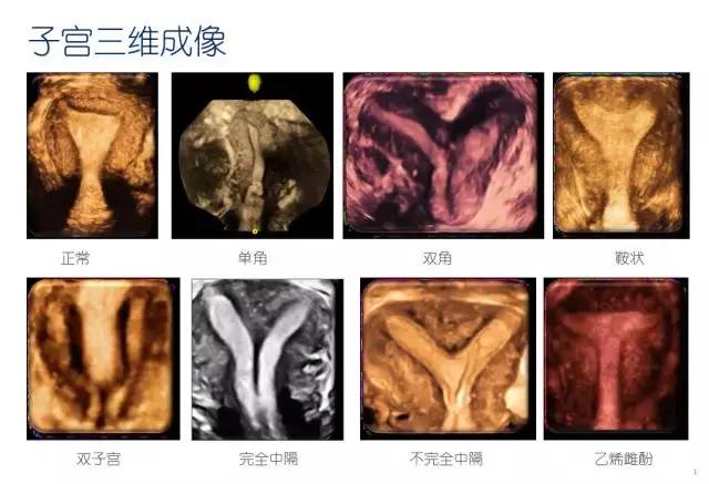 妇科超声波探头,福建省妇幼保健院输卵管超声造影