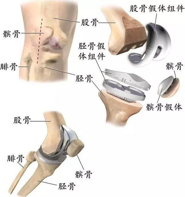 这个病,喜欢运动的人要注意了!医生:不同的损伤治疗方式不同!