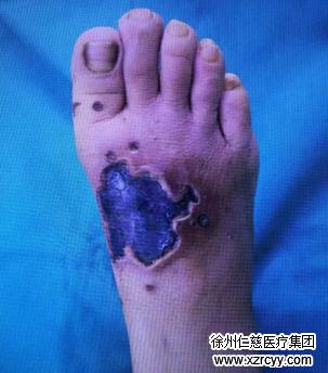 长了个刺瘊子怎么去掉,刺瘊子怎么能治好