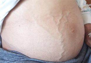 乙型肝炎后肝硬化失代偿期c级,乙肝病毒携带出现肝受损