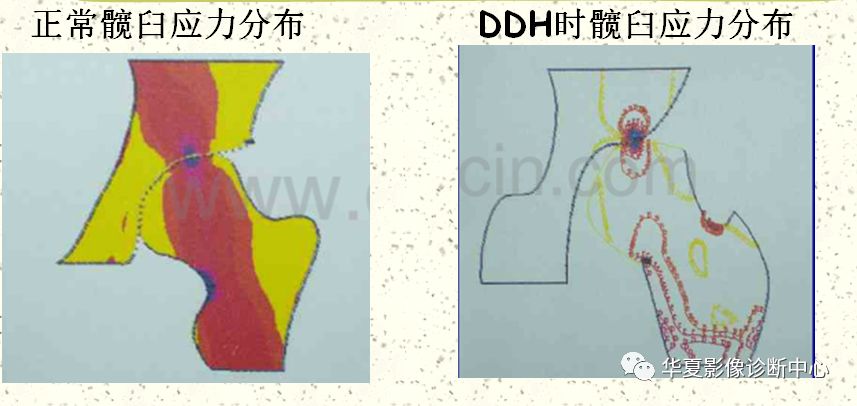 先天性髋关节脱位饮食,先天性髋关节脱位属不属于残疾人