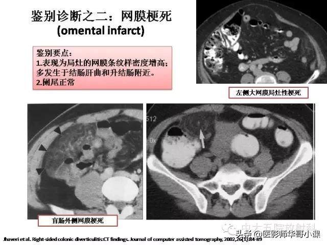 阑尾炎课件,阑尾炎的超声课件