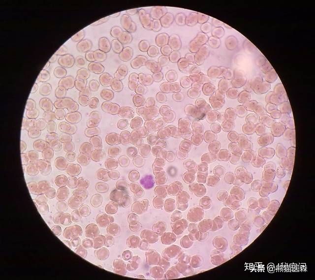 尿常规出现红细胞是胃出血吗,尿常规出现红细胞原因