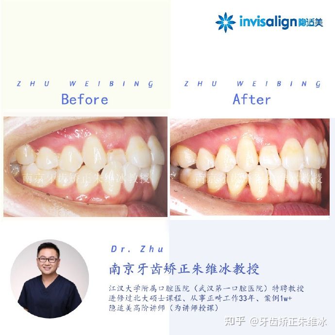 南京牙齿矫正骨性嘴凸案例,郑州牙齿矫正会让脸型更好看吗