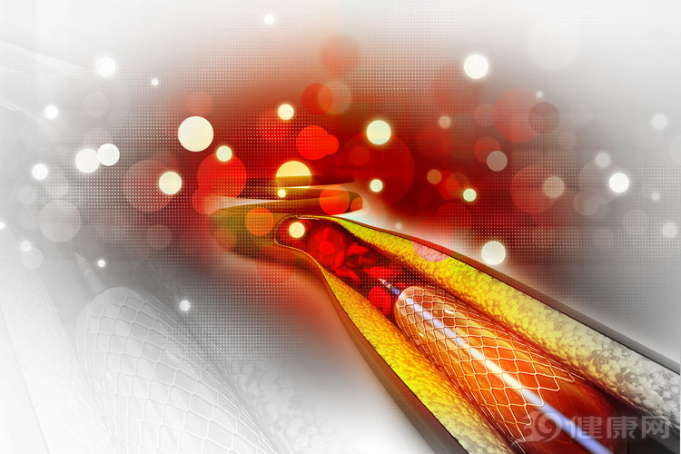 放了支架血管再堵了怎么办,心脏支架后如何避免血管再次堵塞