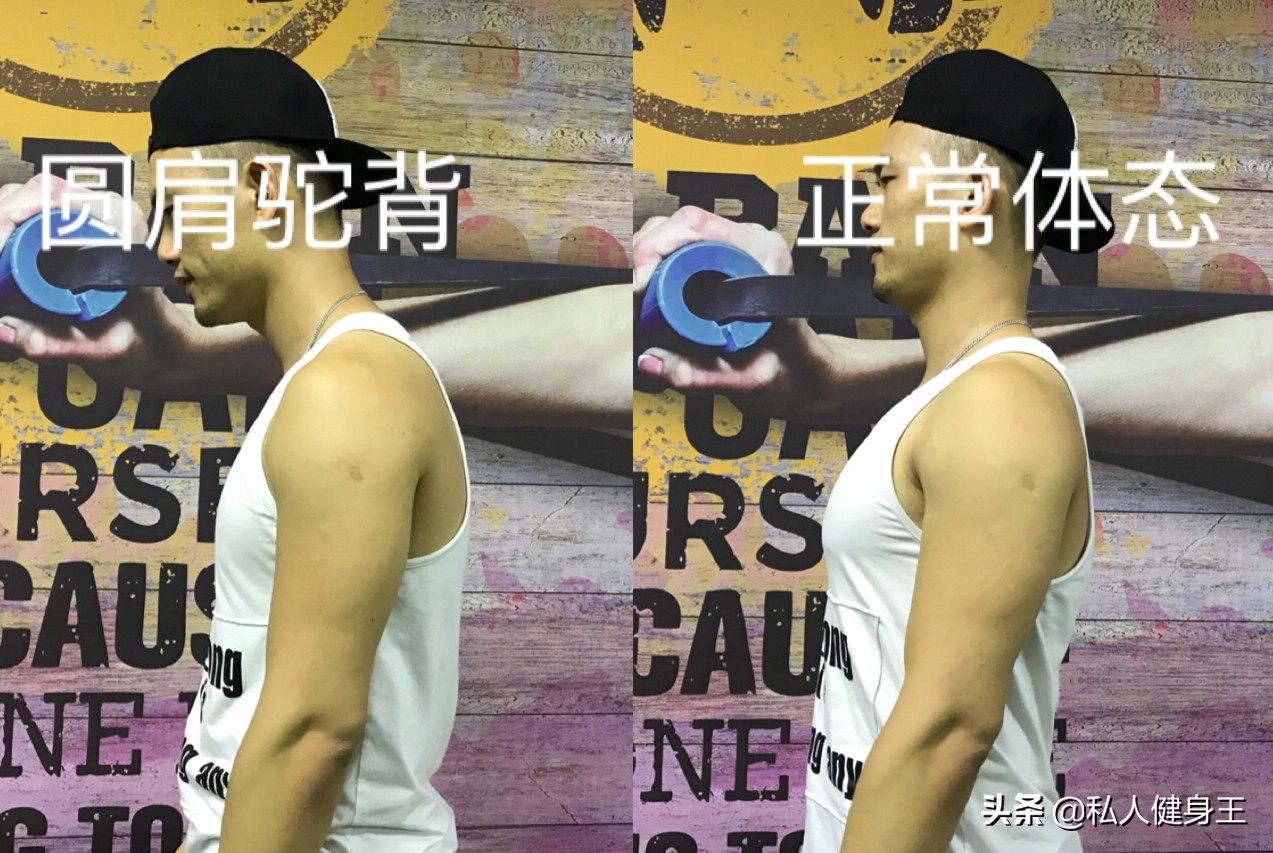 驼背很严重如何矫正,40年驼背站墙根纠正驼背可以吗