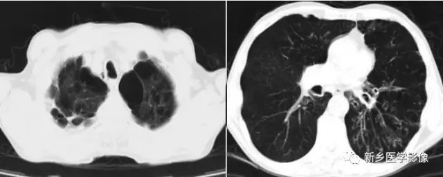 肺部基础免疫,肺基础疾病有哪些