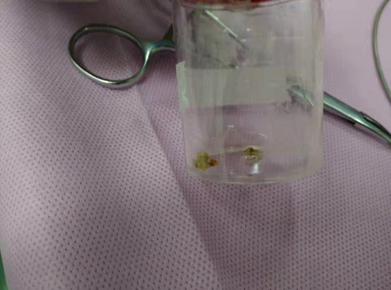 26岁确诊肺癌,26岁得了肺结核