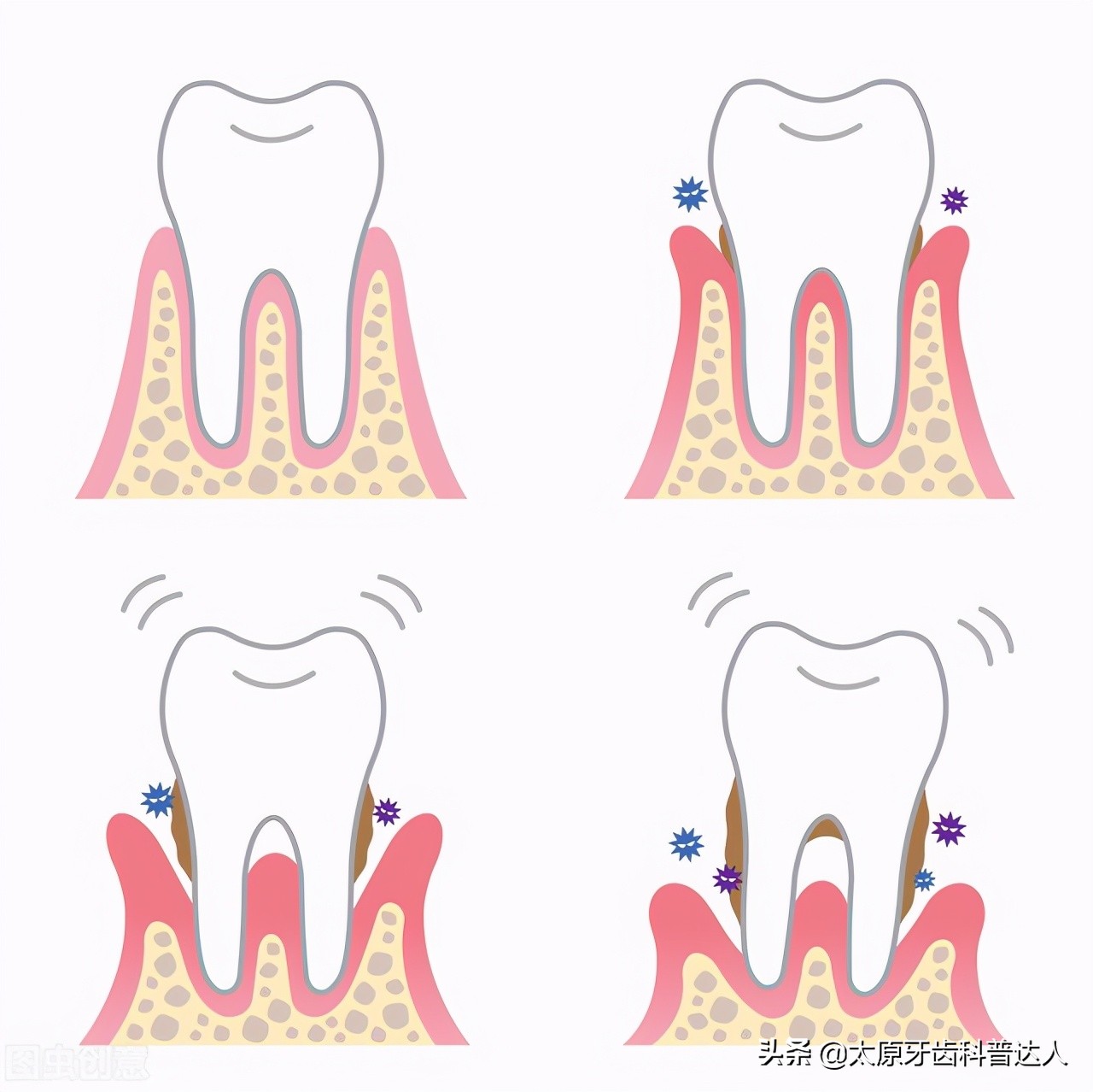 牙周病造成牙齿松动如何治疗？
