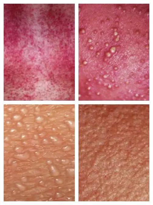 长痱子怎么办婴幼儿,长痱子怎么办