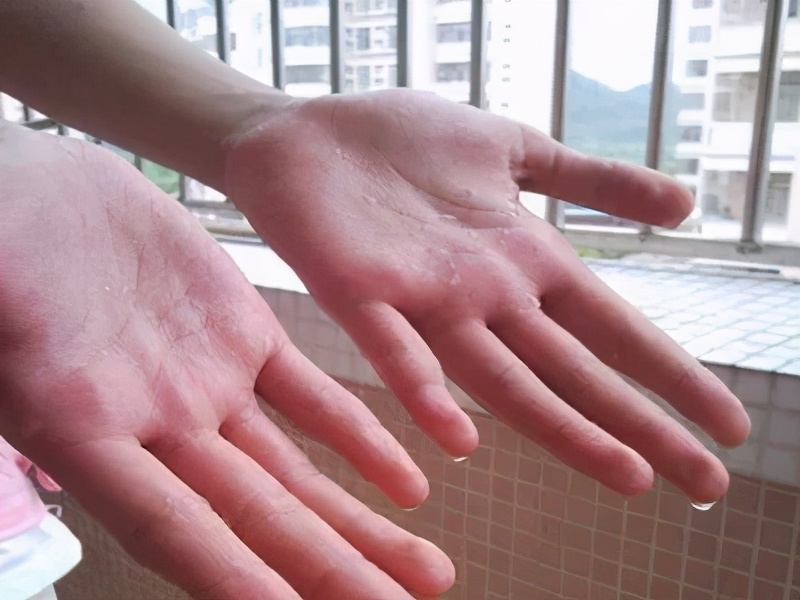 滴水的最佳解决方法,治手汗症最简单的方法