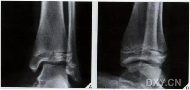 特殊骨折类型,特殊骨折体征