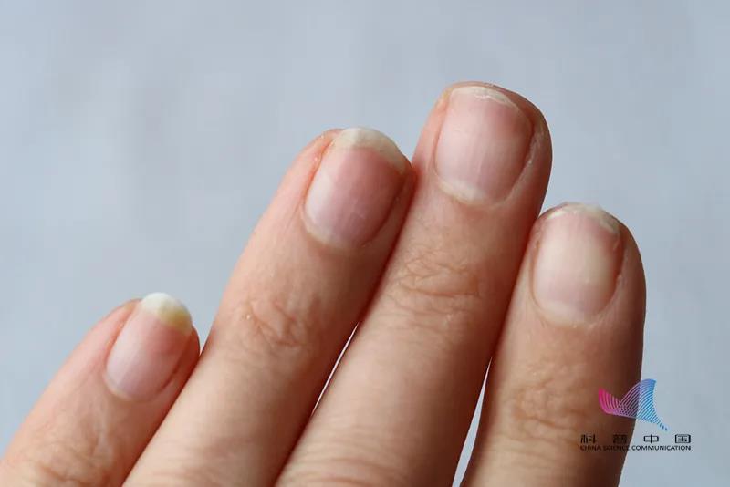 指甲竖纹发白变厚是怎么回事,涨知识了说明什么