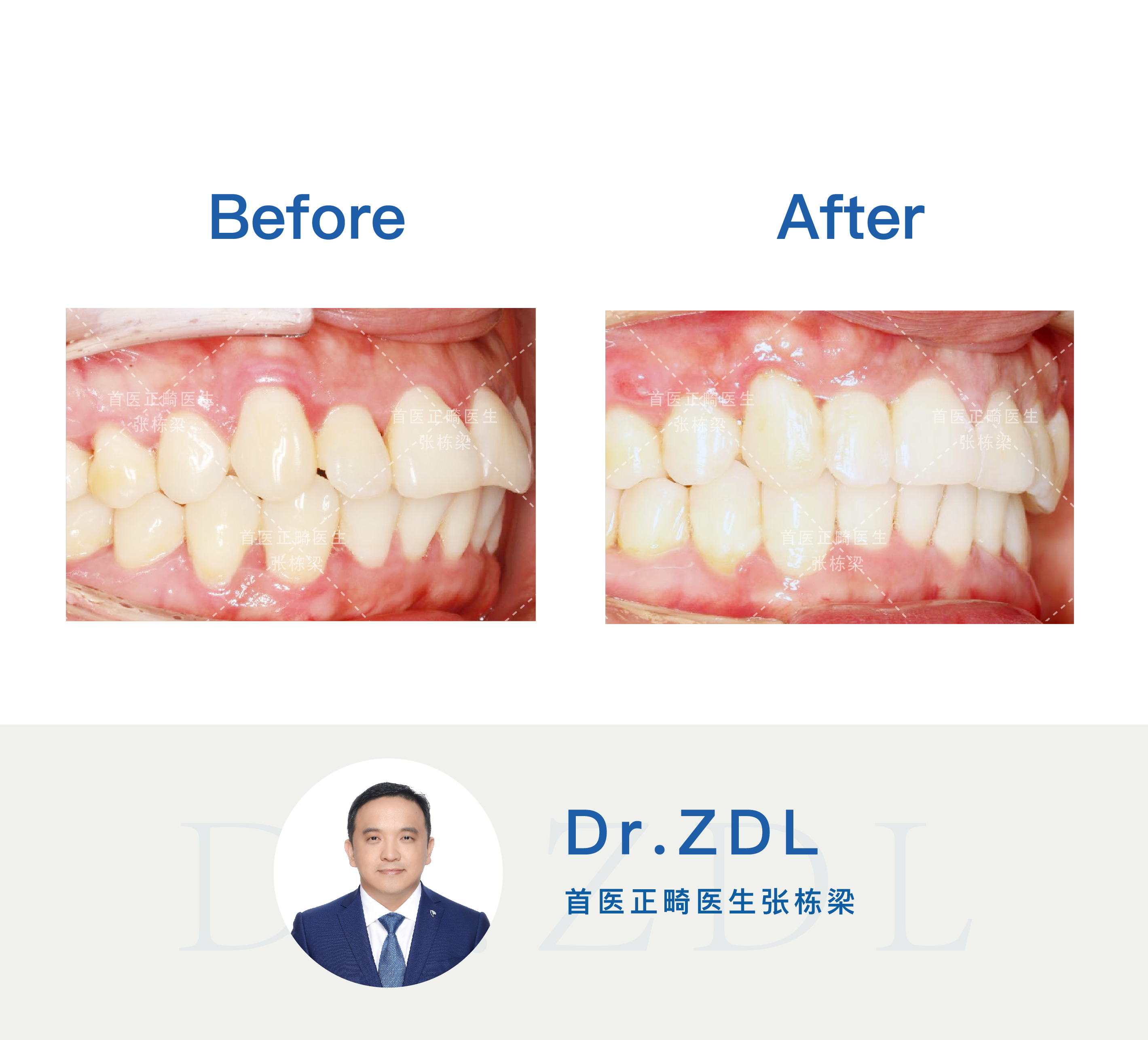 嘴突不做牙齿矫正后果,嘴突没有龅牙可以修复吗