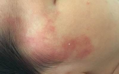 红胎记和青胎记哪个好治疗,红胎记血管瘤的治疗方法有哪些