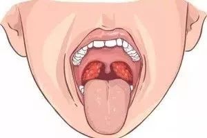 扁桃体发炎与扁桃体癌的区别,扁桃体瘤和扁桃体癌的区别