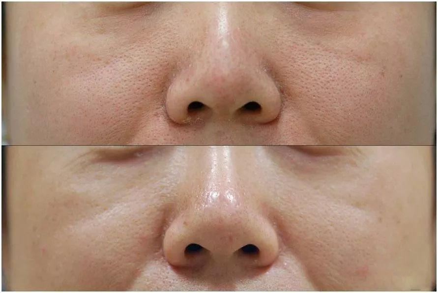 毛孔出油粗大如何改善小技巧,怎么应对肌肤毛孔粗大