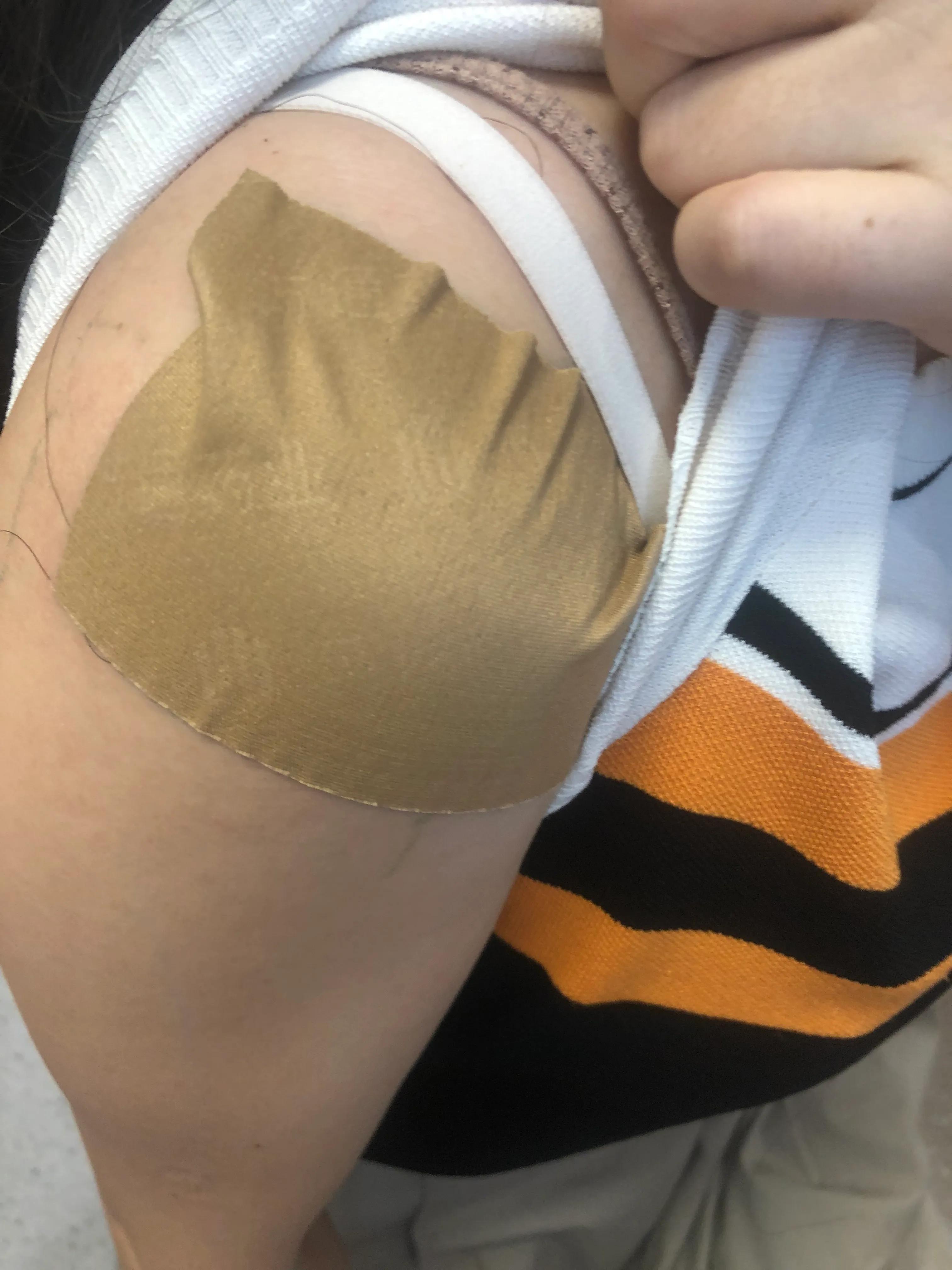 贴药膏过敏了过一个星期能治好吗,贴膏药过敏了怎么办最快方法