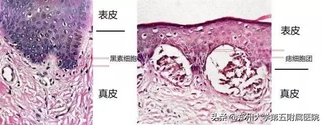 点痣那点事儿,激光点痣视频