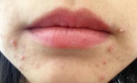 天天在家熬夜身上长痘,在家熬夜玩手机